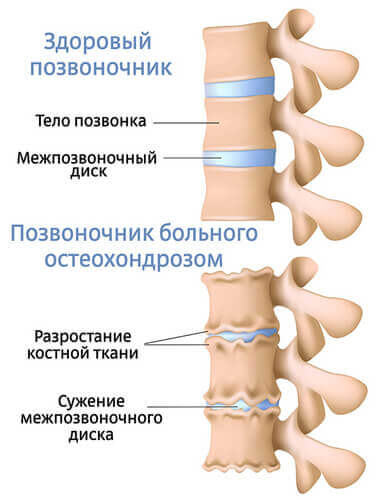 лечение остеохондроза в домашних условиях