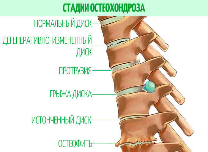 После поднятия тяжести болит спина: почему, первая помощь, методылечения