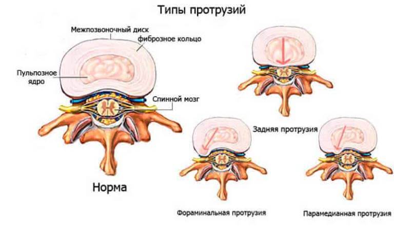 Фото межпозвонковая грыжа поясничного отдела позвоночника