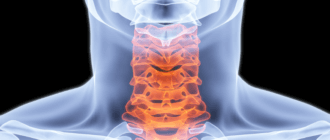 Онлайн тест на шейный остеохондроз