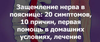 Защемление нерва в пояснице: 20 симптомов, 10 причин, первая помощь в домашних условиях, лечение