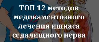 Ишиас (воспаление седалищного нерва): медикаментозное лечение (обезболивающие таблетки, свечи, мази)