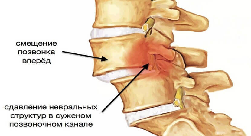 как вправить позвонки самостоятельно