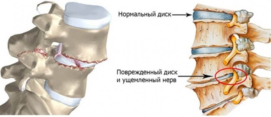 симптомы смещения позвонков