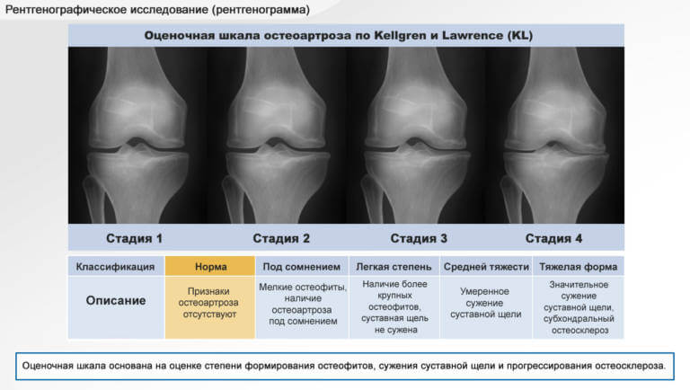 Схема лечения артроза коленного сустава 2 степени