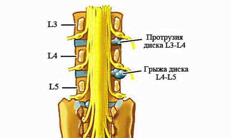 При протрузии дисков поясничного отдела какая физическая нагрузка разрешена
