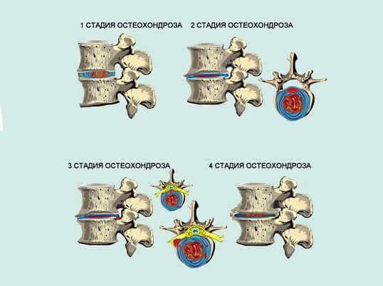 Стадии остеохондроза позвоночника картинки