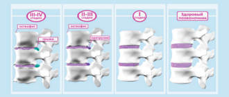 Классификация всех стадии остеохондроза: полное описание, сколько степеней существует , как определить