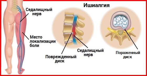 Люмбоишиалгия поясничного отдела позвоночника карта вызова